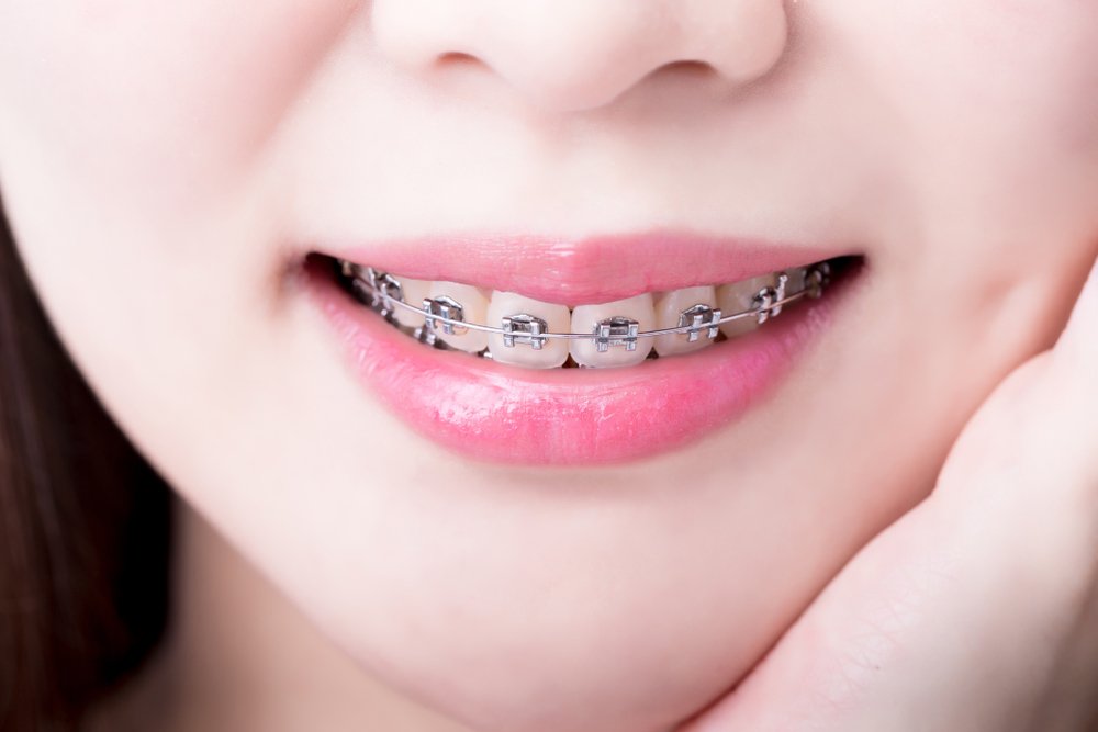 Fixed Braces