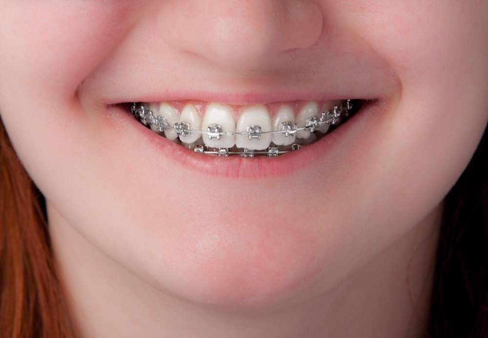 Fixed Braces
