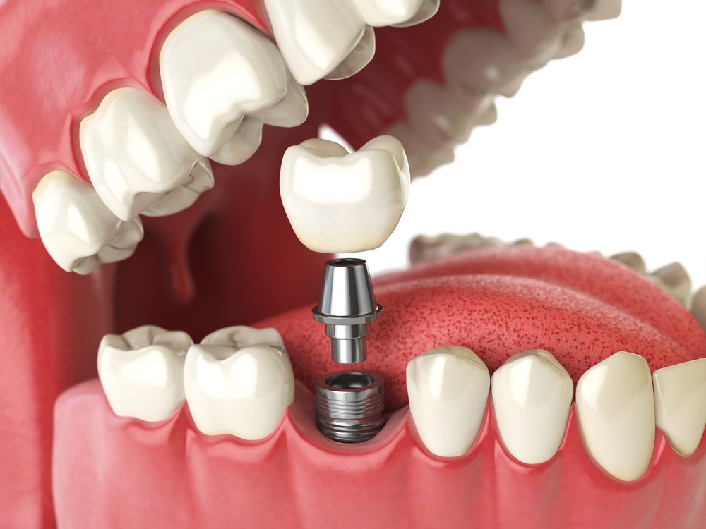 Dental Implants & Crowns