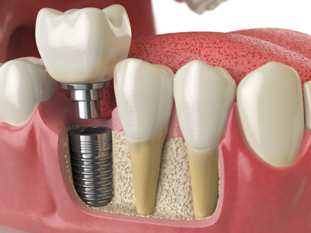 Dental Implants & Crowns