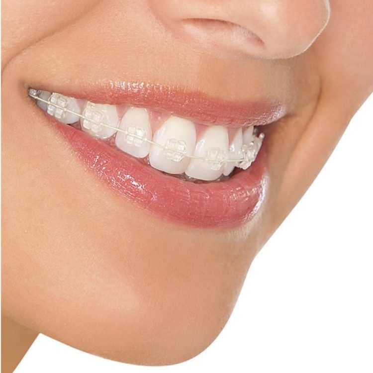 Fixed Braces