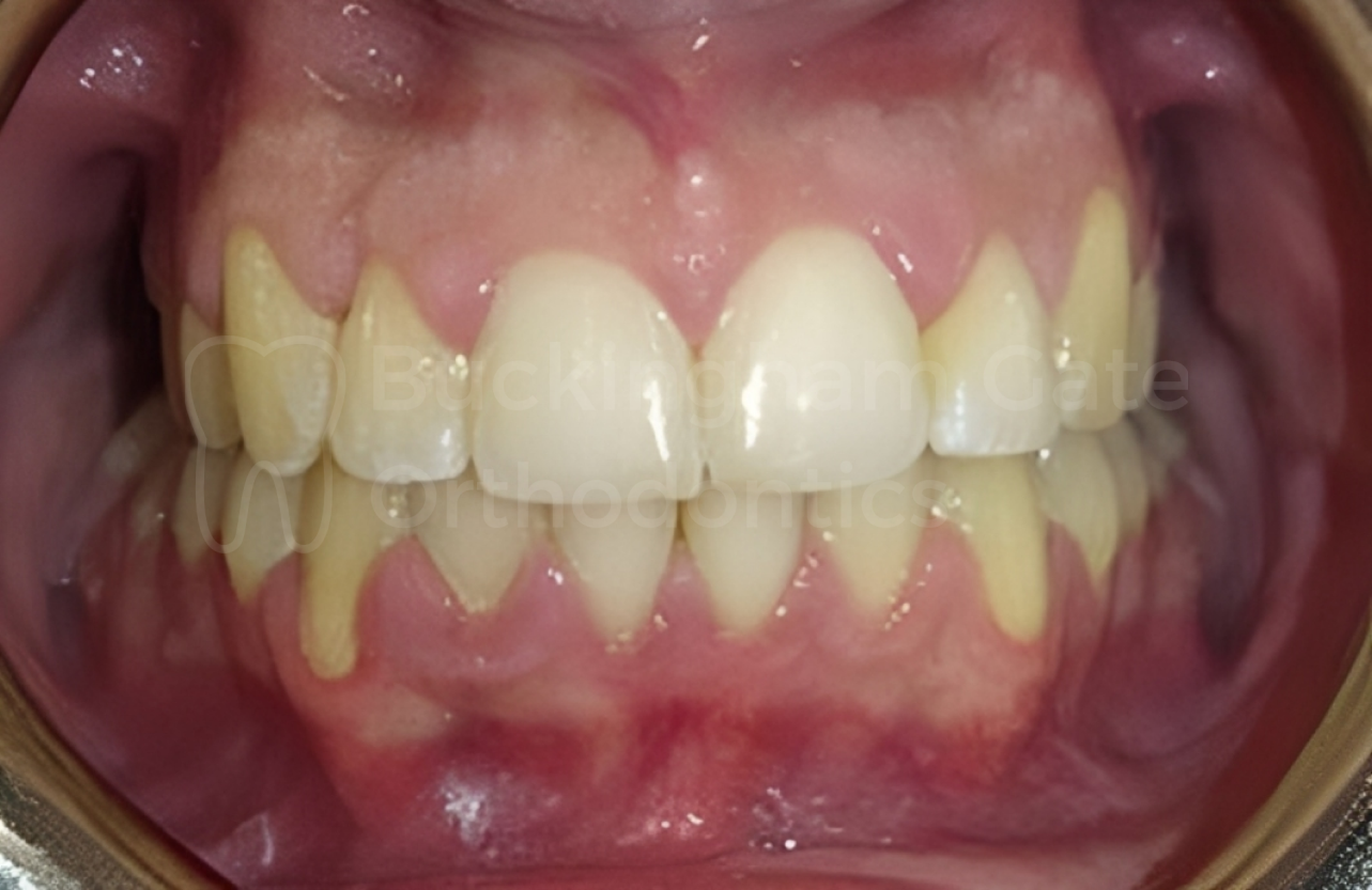 Affordable Braces in Miami – Miami Bay Oral Health