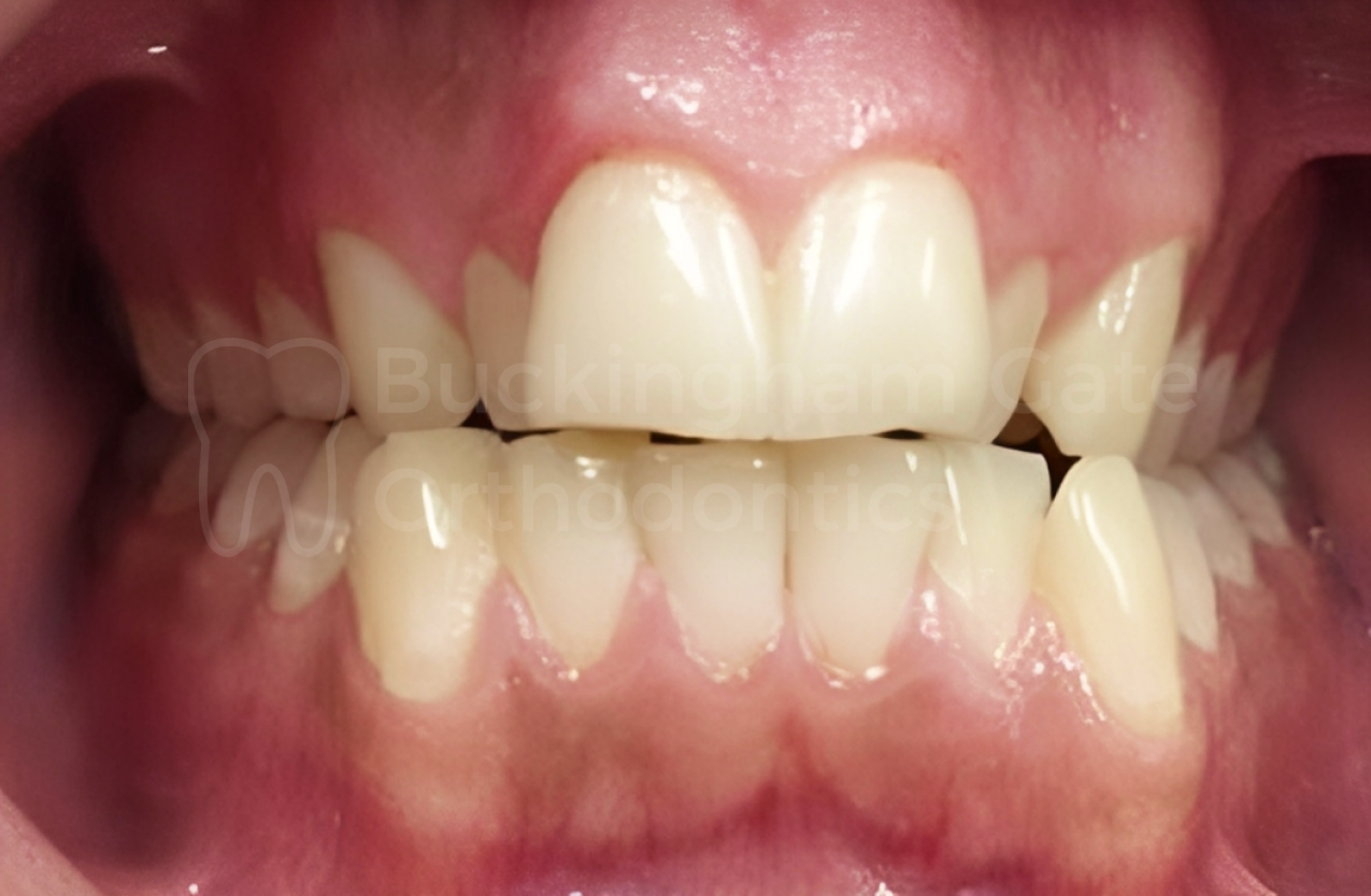 Affordable Braces in Miami – Miami Bay Oral Health