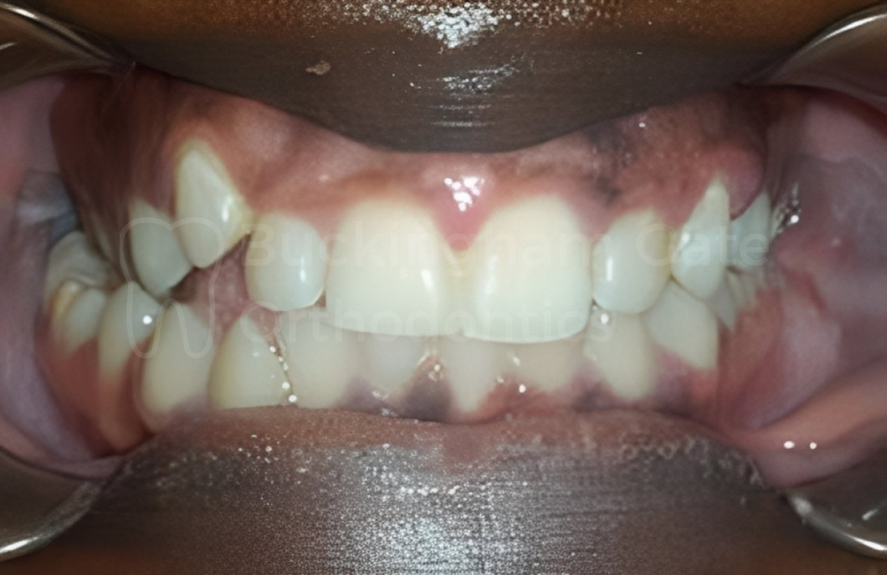 Affordable Braces in Miami – Miami Bay Oral Health