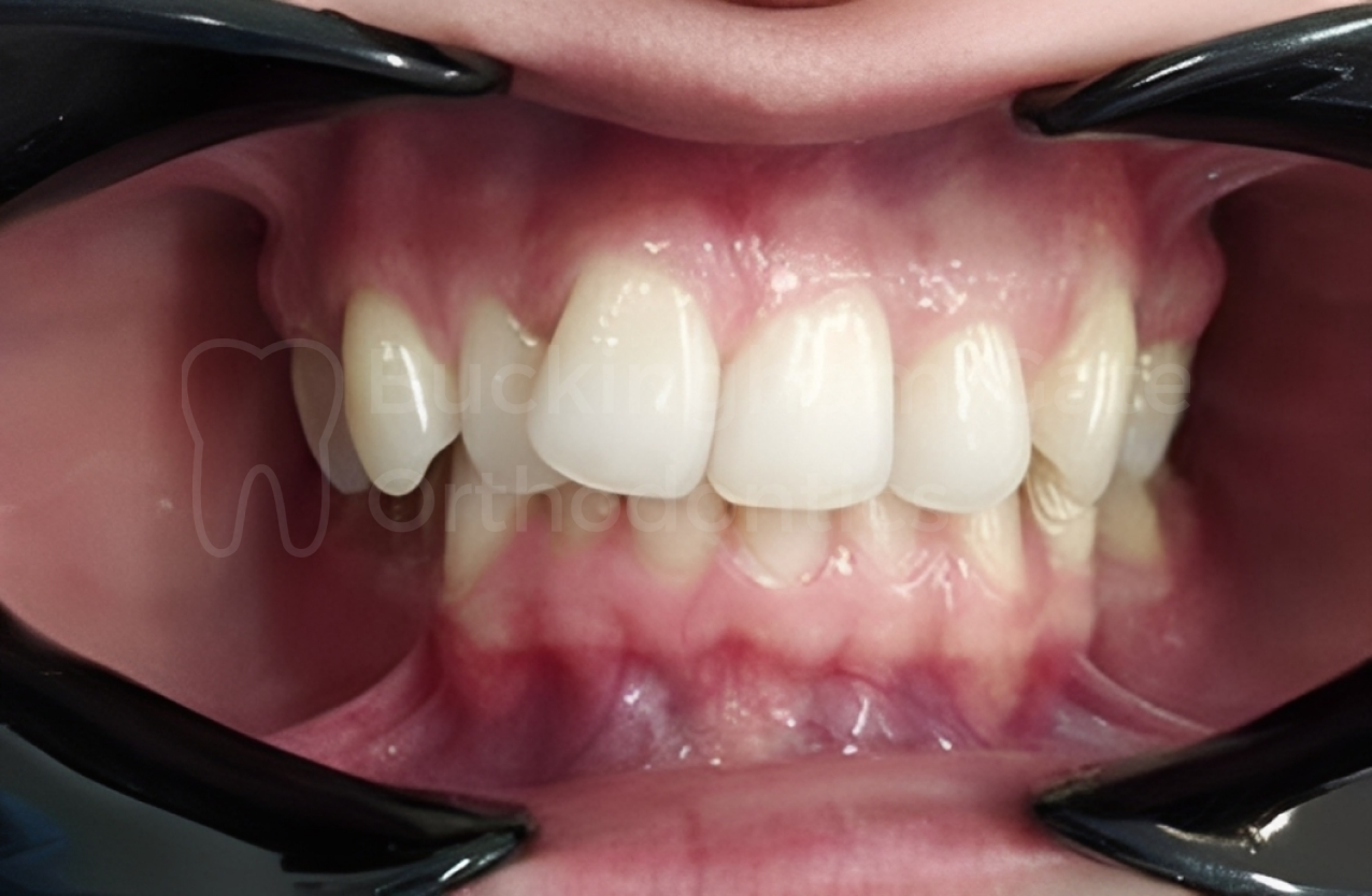 Affordable Braces in Miami – Miami Bay Oral Health