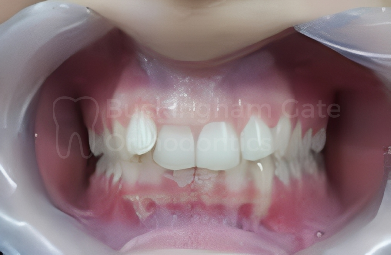 Affordable Braces in Miami – Miami Bay Oral Health