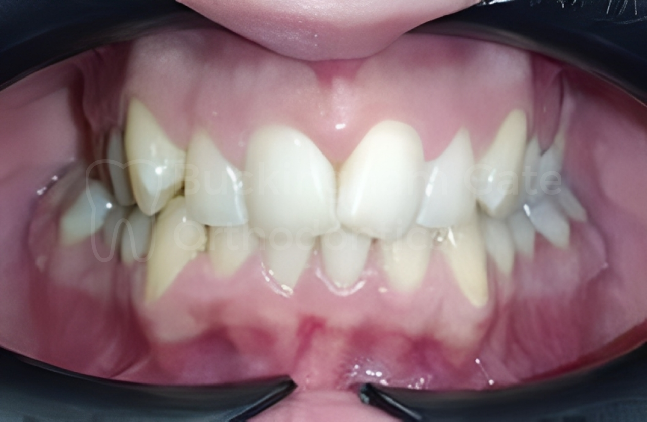 Affordable Braces in Miami – Miami Bay Oral Health