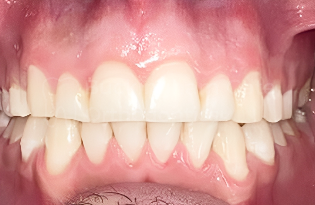 Affordable Braces in Miami – Miami Bay Oral Health