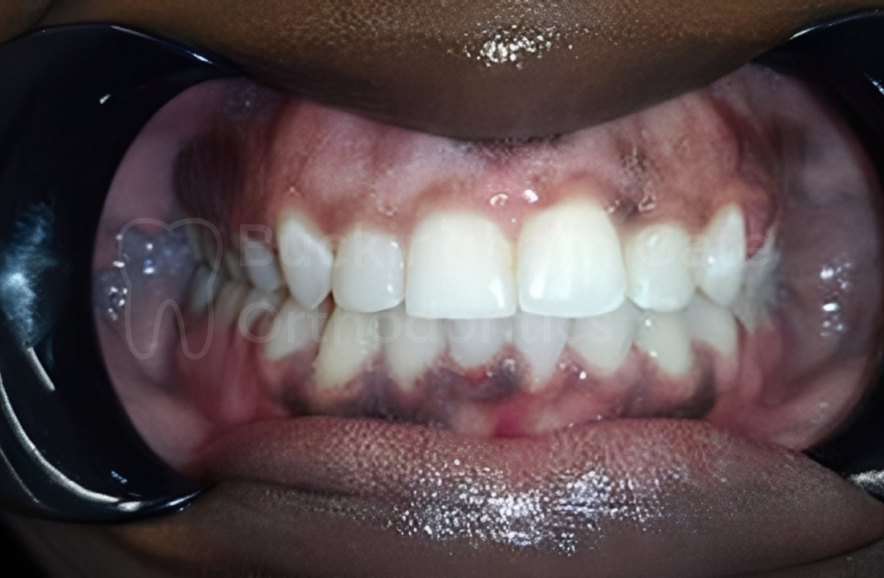 Affordable Braces in Miami – Miami Bay Oral Health