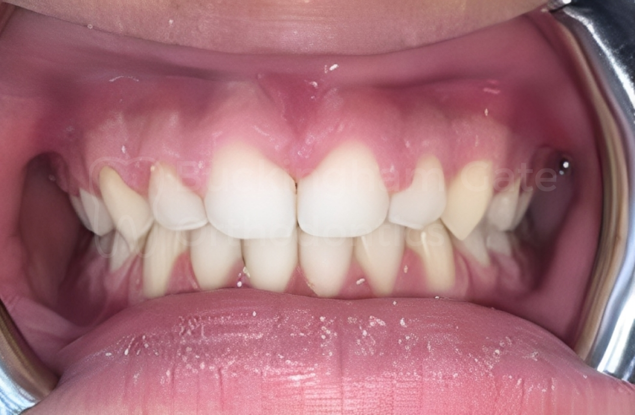 Affordable Braces in Miami – Miami Bay Oral Health