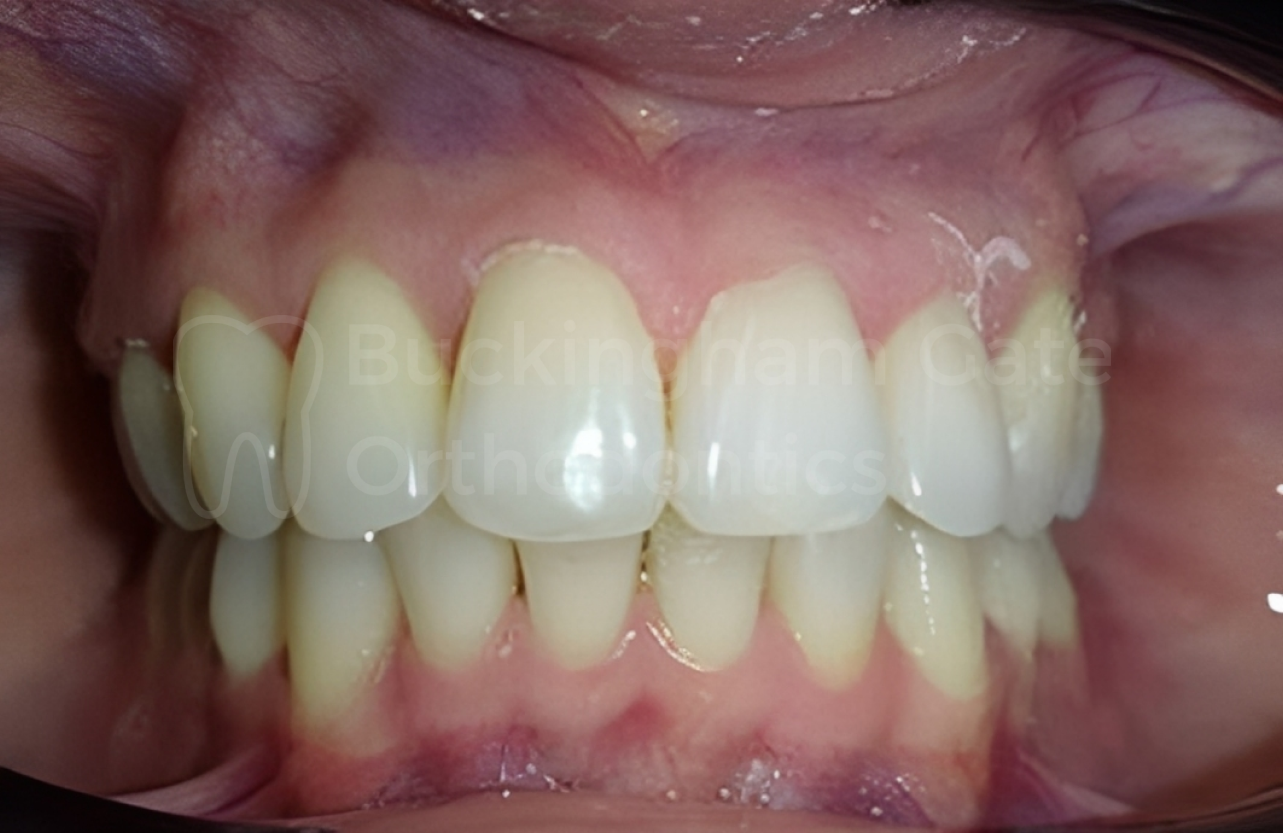 Affordable Braces in Miami – Miami Bay Oral Health