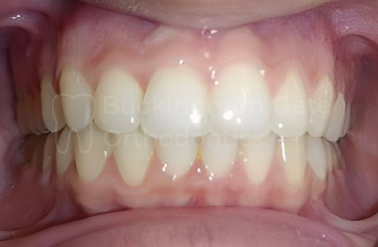 Affordable Braces in Miami – Miami Bay Oral Health